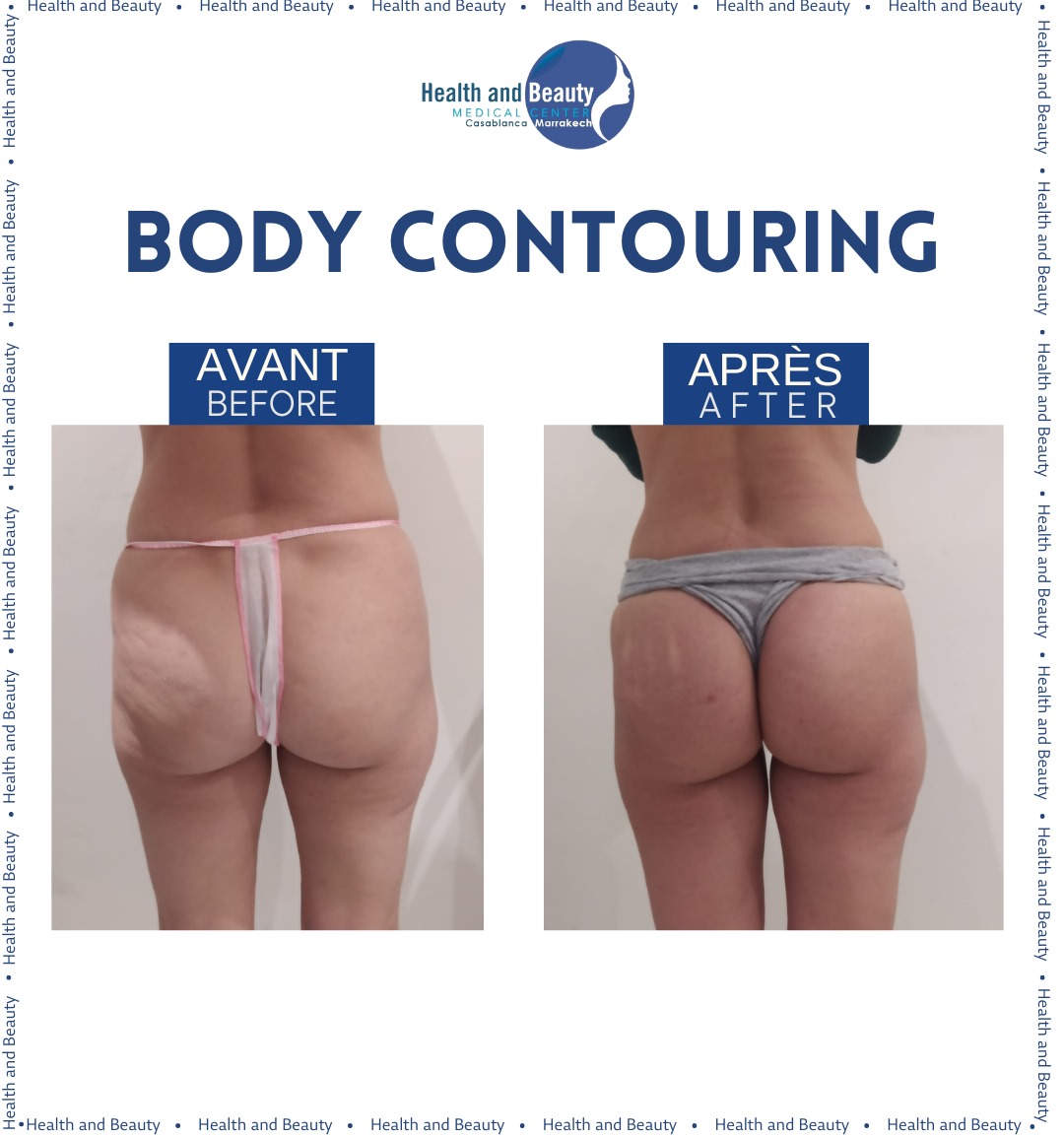 resultat-body-contouring-cellulite