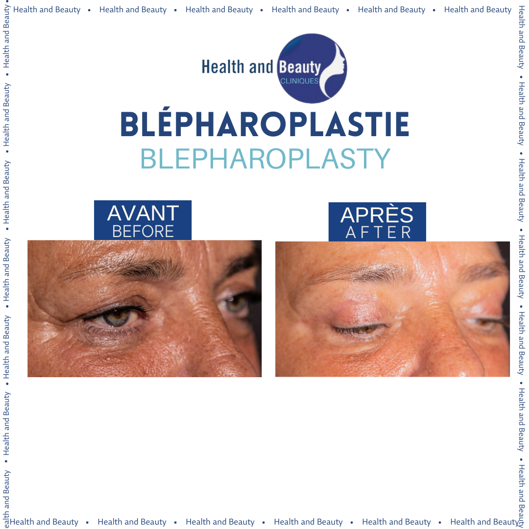avant-apres-blepharoplastie-droite