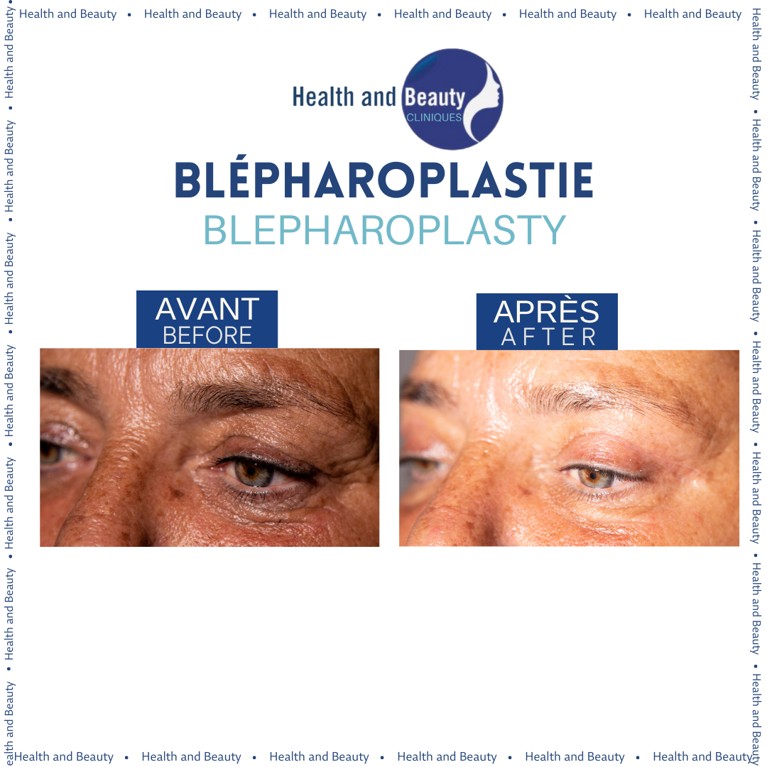 avant-apres-blepharoplastie-gauche