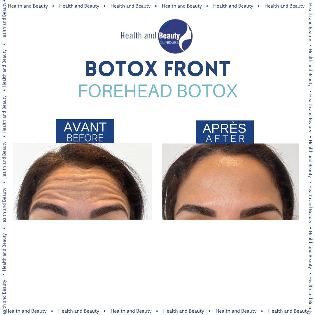 avant-apres-botox-front