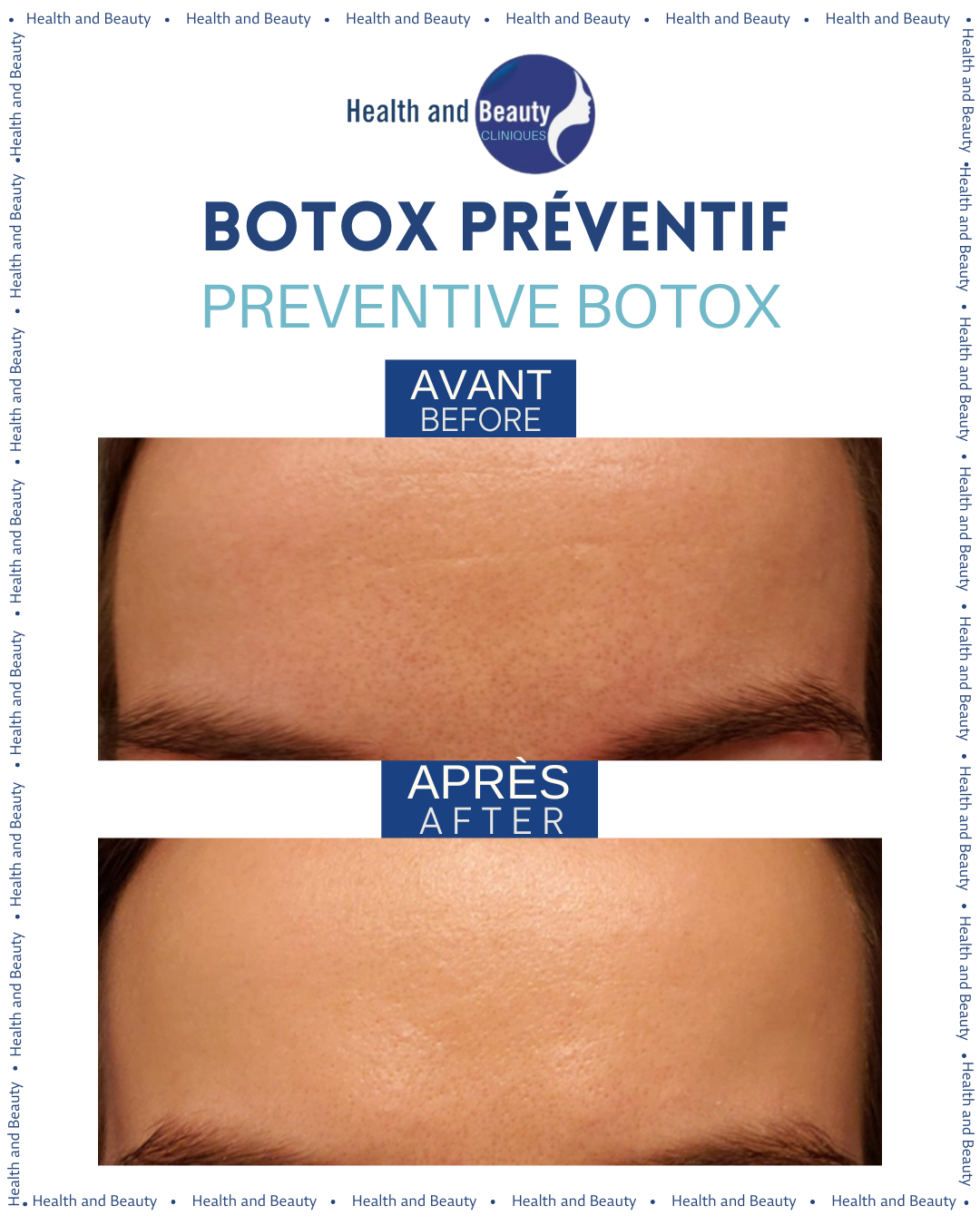  botox préventif avant après rides expression visage