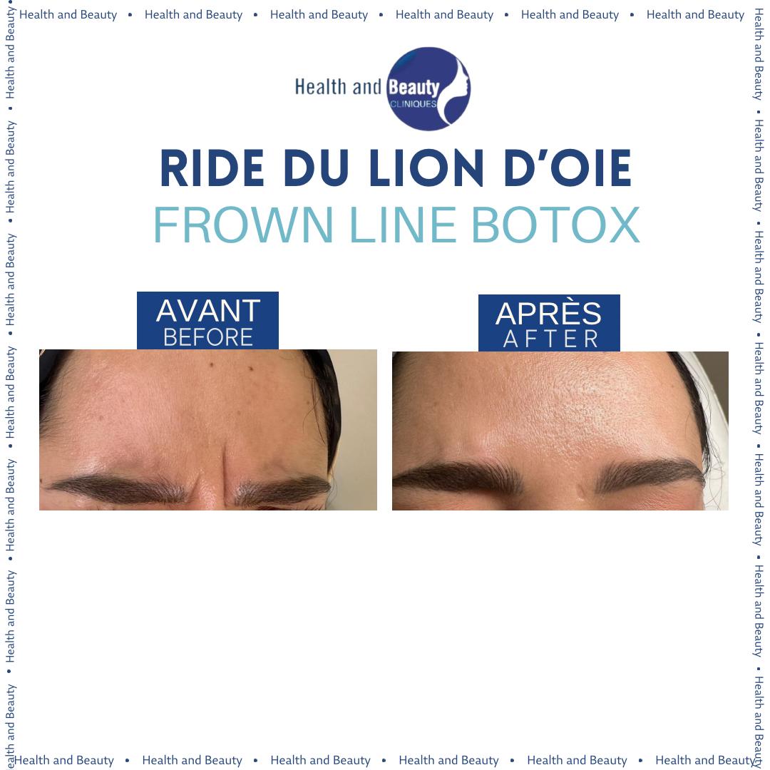 avant-apres-botox-ride-du-lion-frown-lines-wrinkles