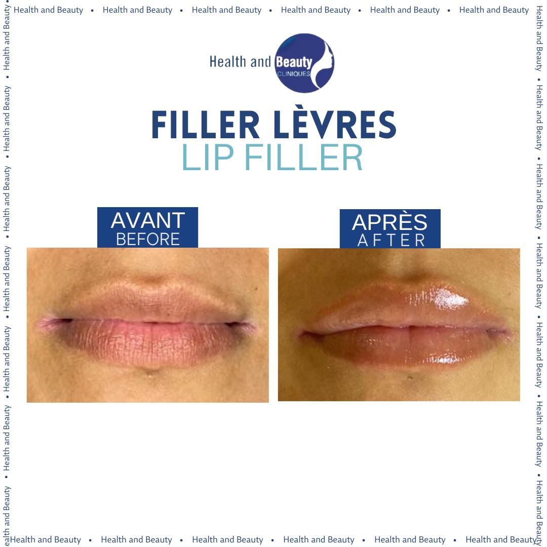 avant-apres-filler-levres-lip-filler-plumped-lips