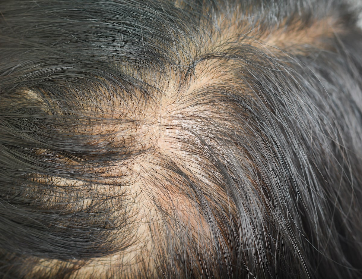 perte-de-cheveux-diffuse-reactionnelle