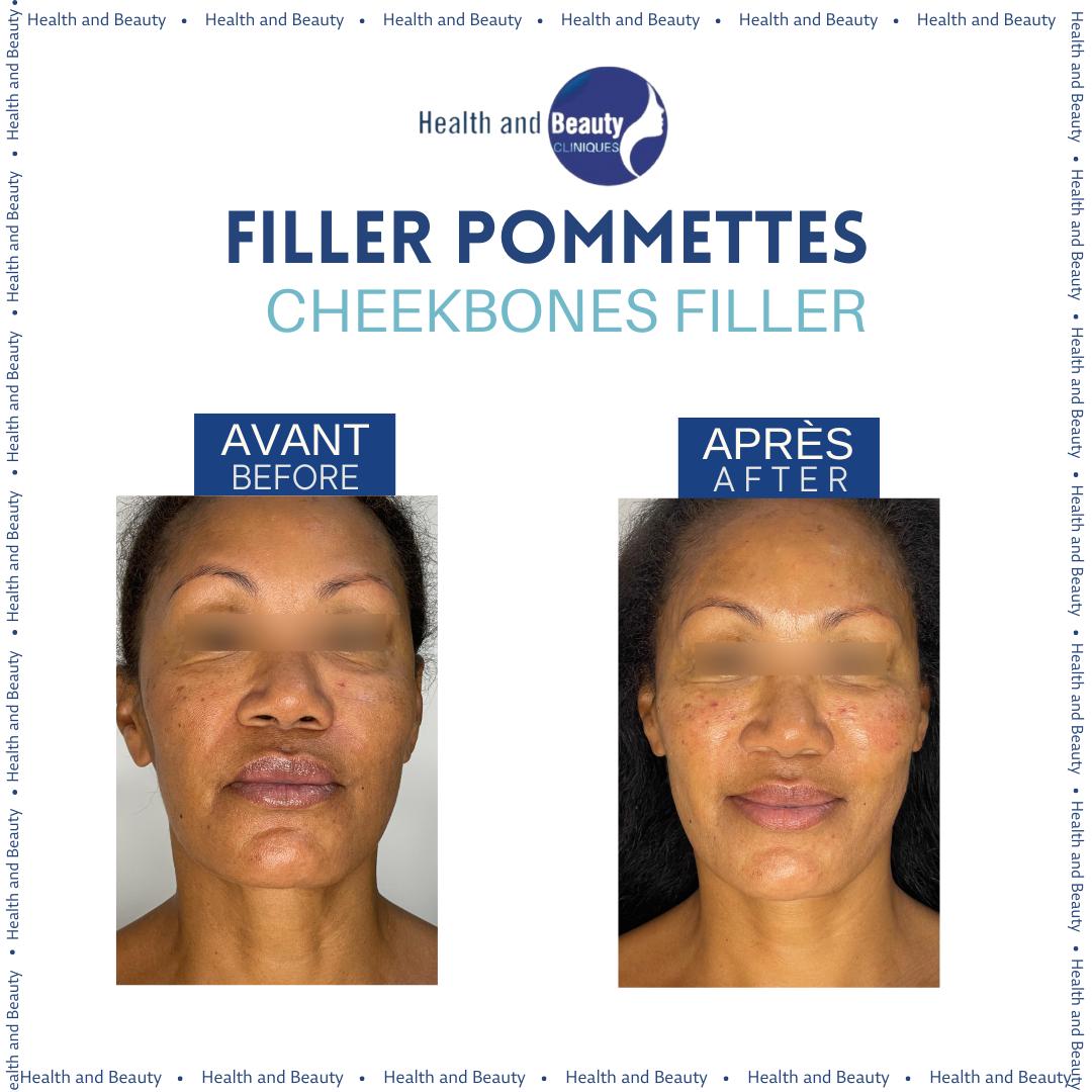 cheekbones-filler-result-filler-pommettes