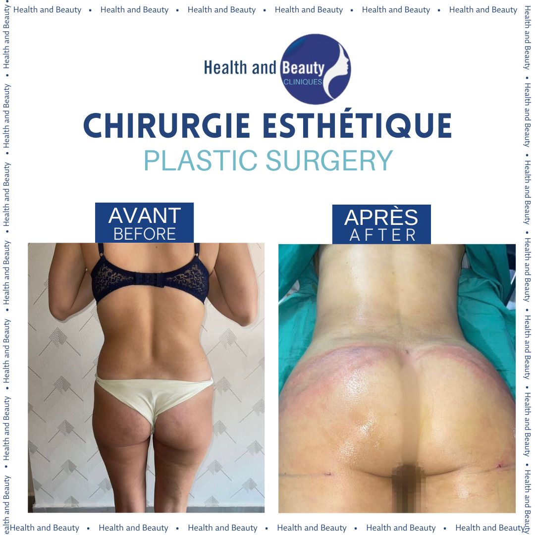 chirurgie-esthetique-plastic-surgery-results-morocco