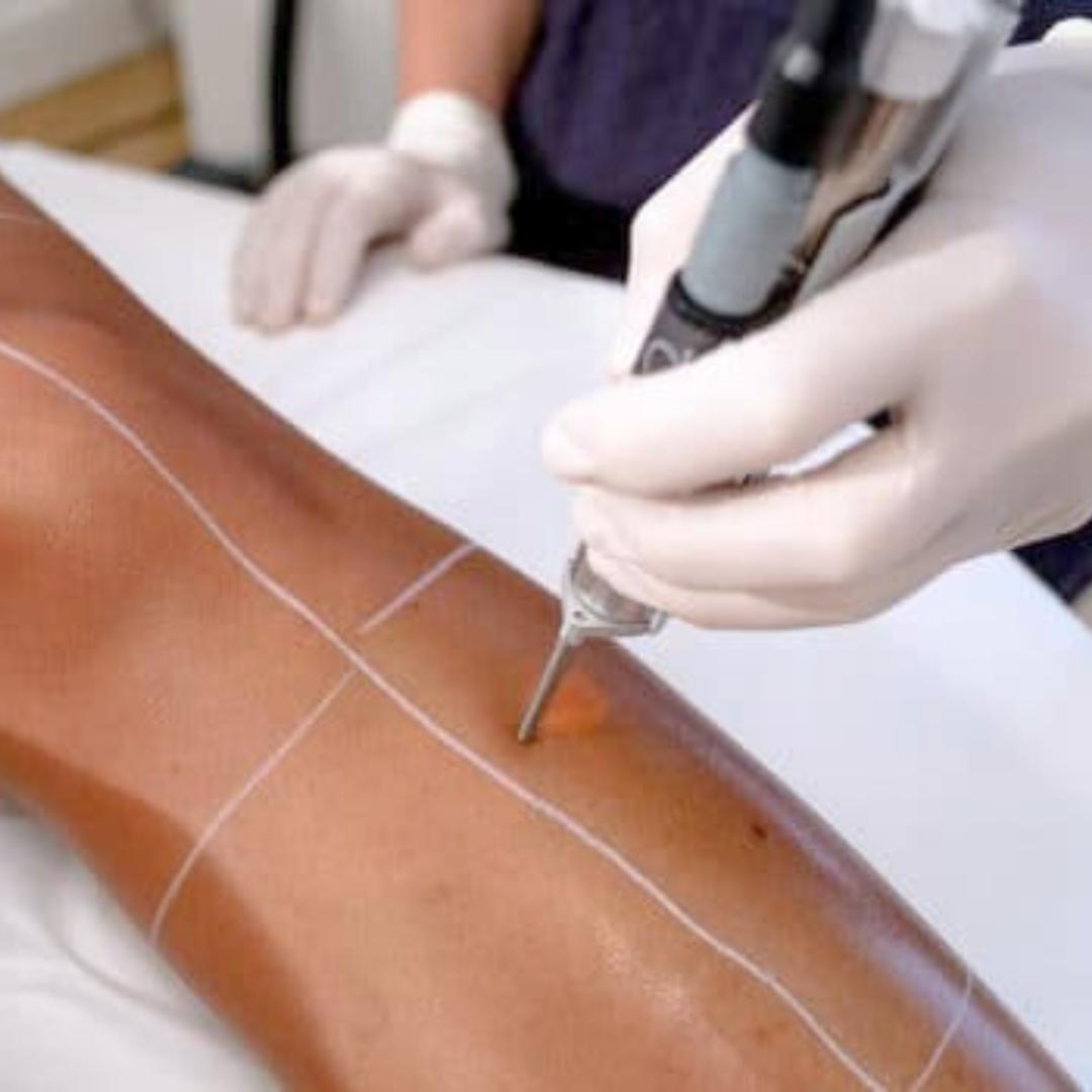 deroulement-de-seance-epilation-laser-jambes-completes