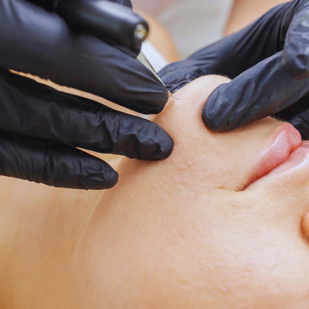 epilation-definitive-electrolyse-casablanca-marrakech-rabat