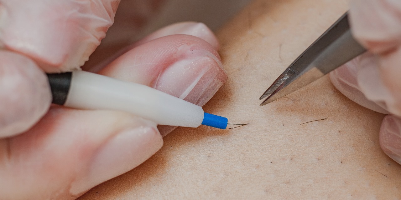 epilation-electrolyse-prix-maroc-visage