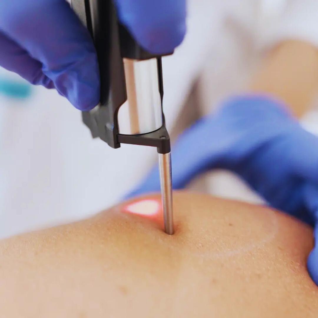  epilation-laser-definitive-alexandrite-et-ndya