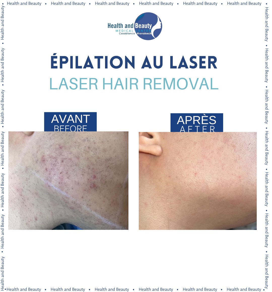 laser-hair-removal-cynosure-IQ