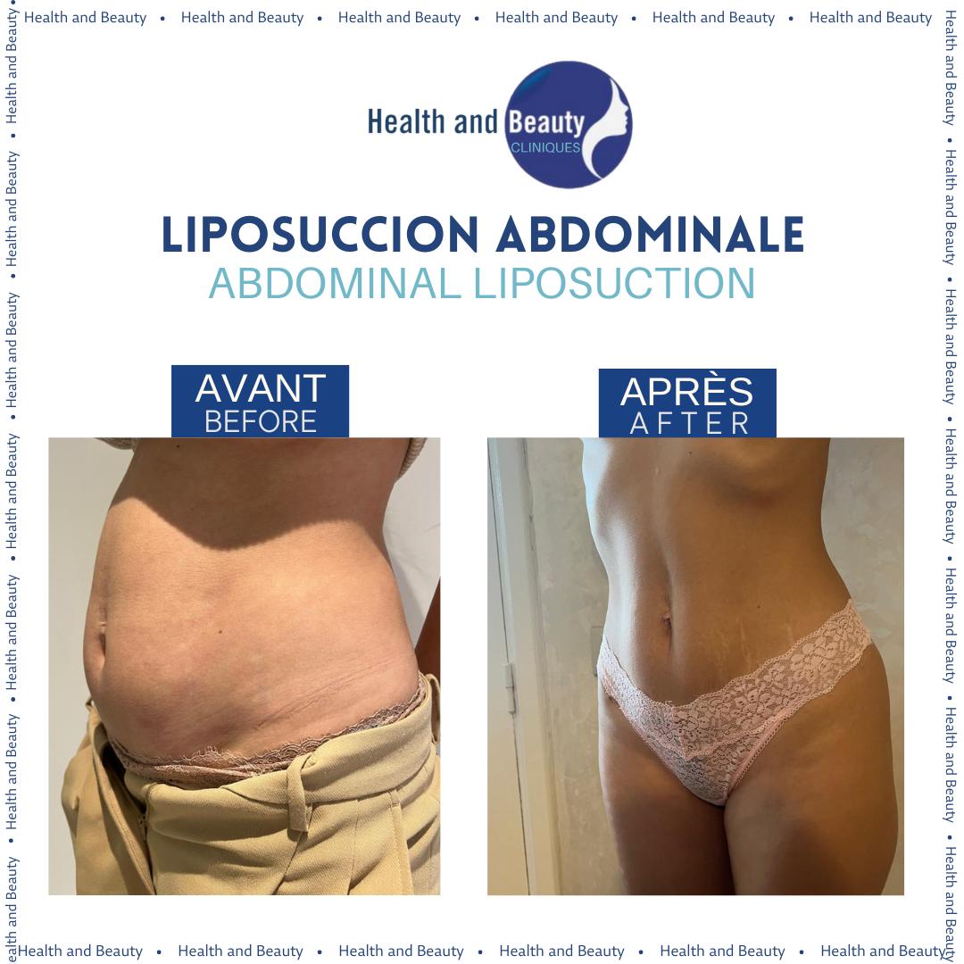 liposuccion-abdominale-resultat-avant-apres-graisses