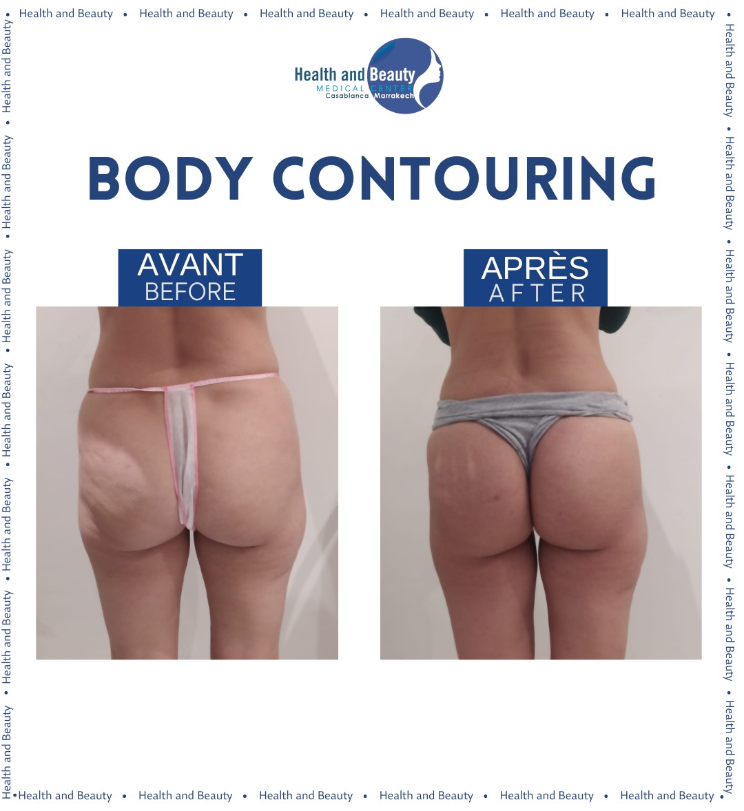 liposuccion-double-menton-maroc-casablanca-marrakech-rabat