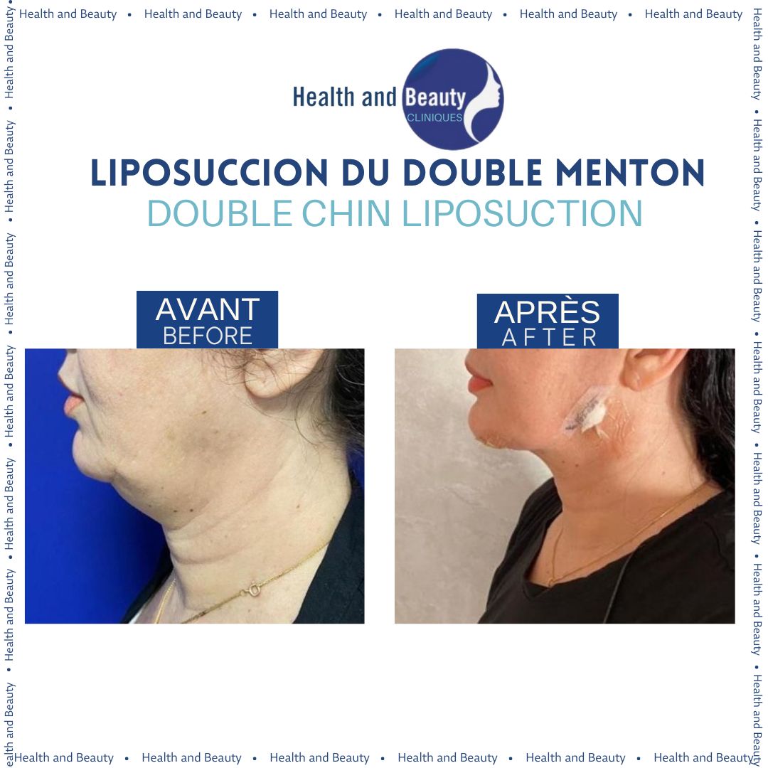 liposuccion-du-double-menton-resultat-slimmer-jawline