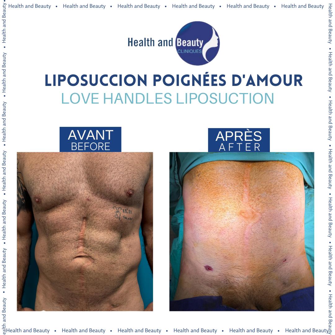 avant-apres-blepharoplastie