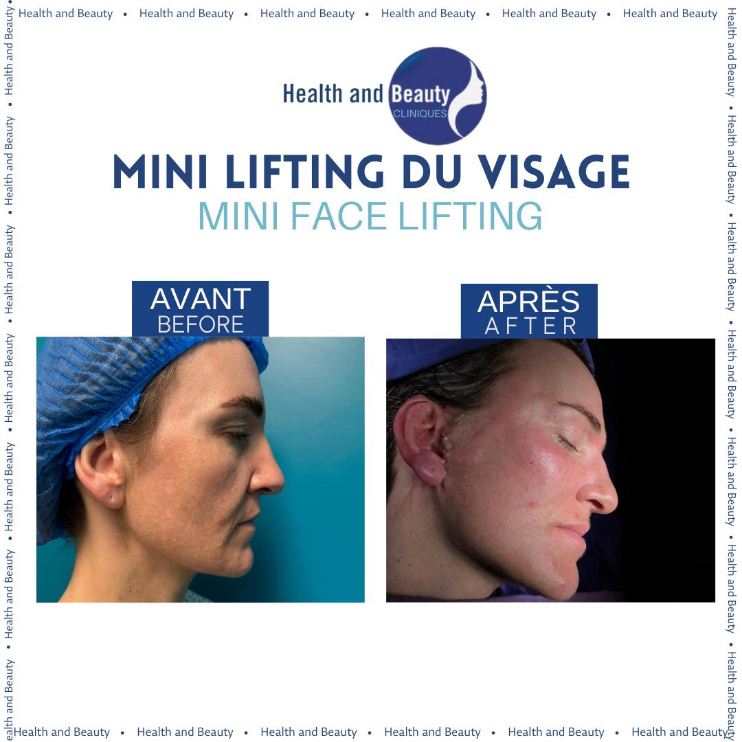 mini-lifting-chirurgie-visage-au-maroc-resultat-rajeunissement-visage