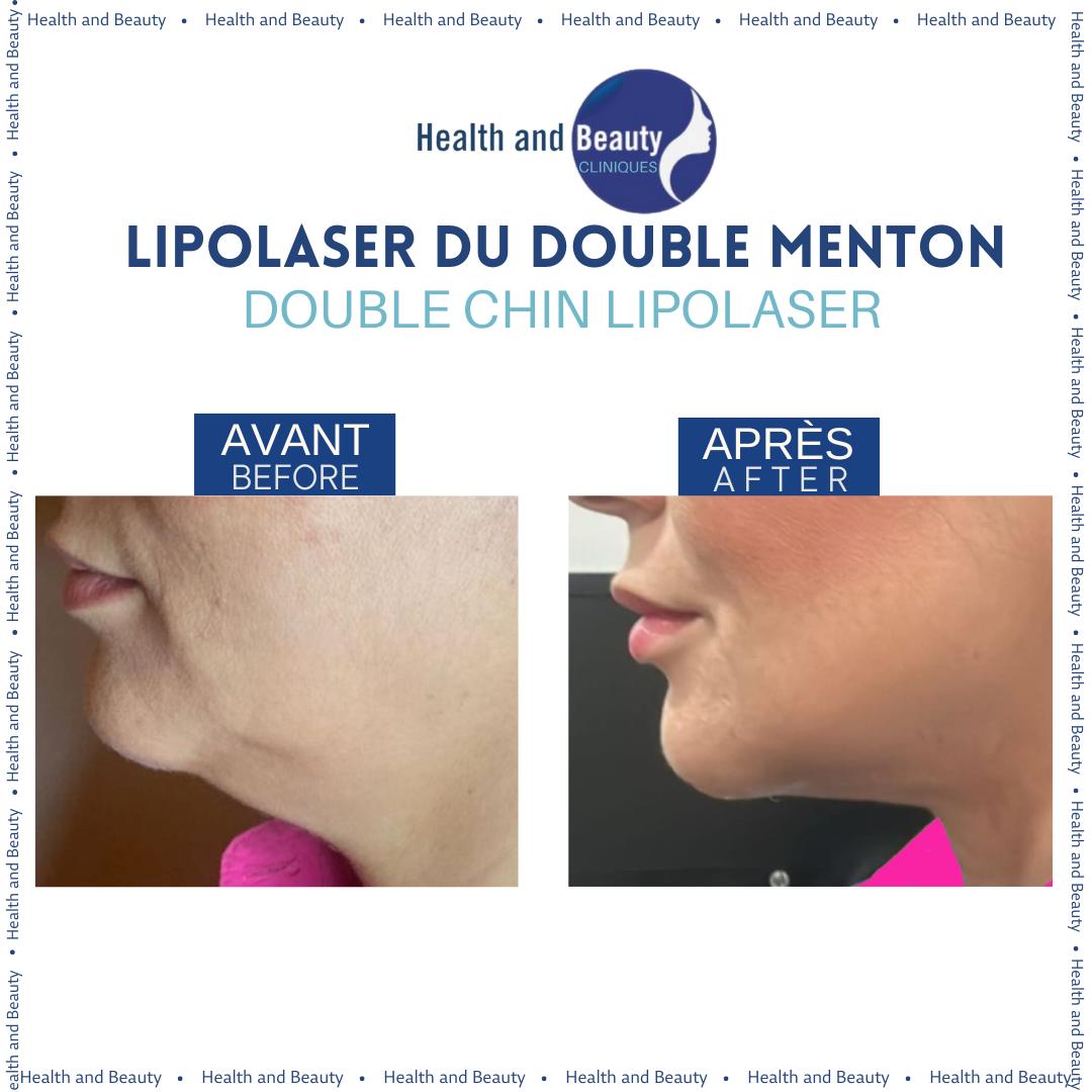 mini-liposuccion-lipolaser-du-double-menton