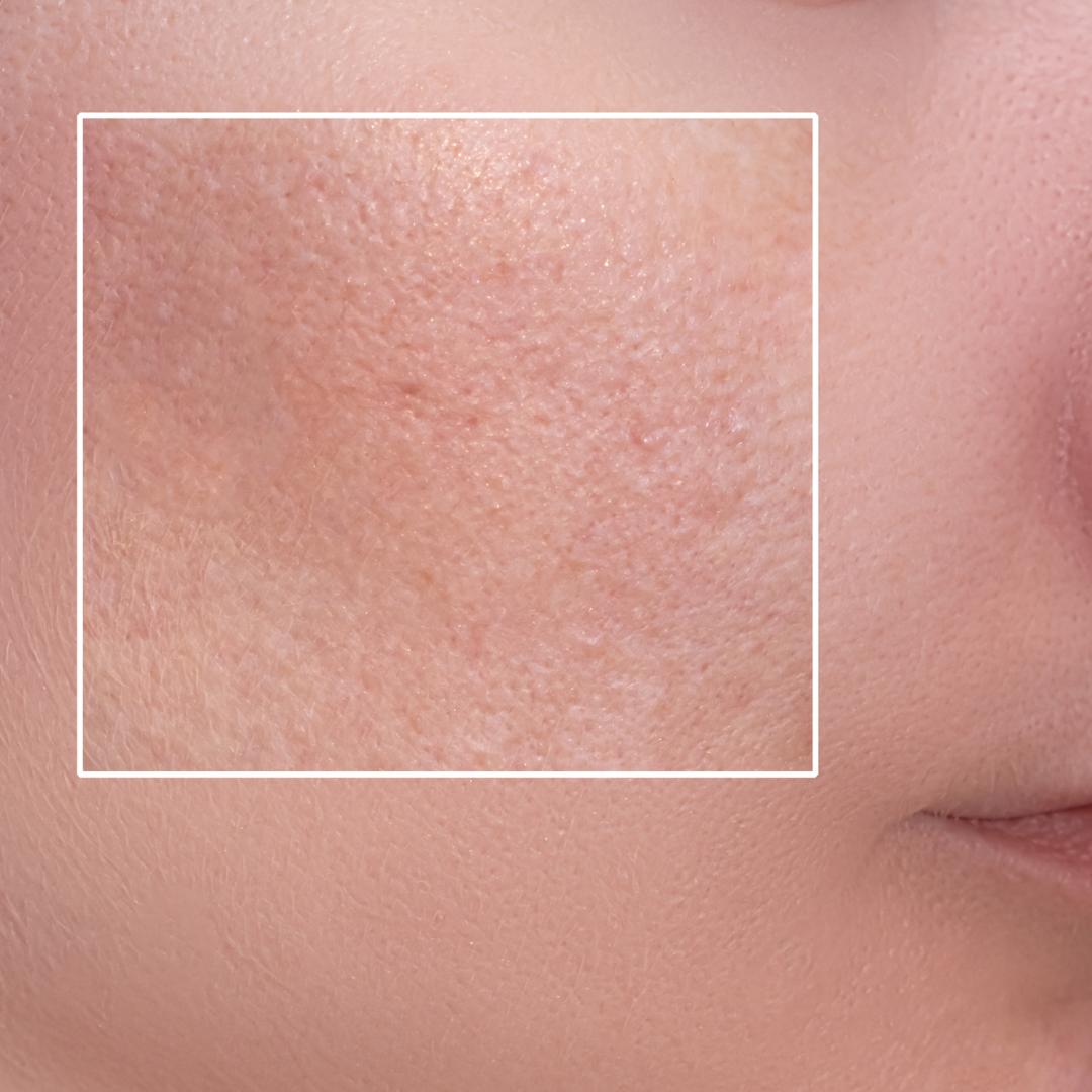 pores-dilates-peau-grasse