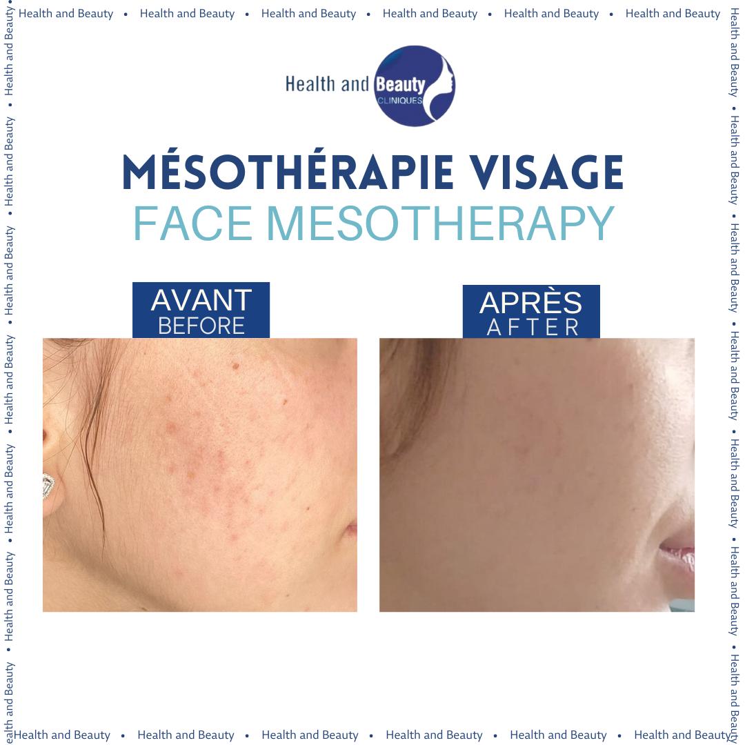 resultat-avant-après-mésothérapie-visage-health-and-beauty_maroc
