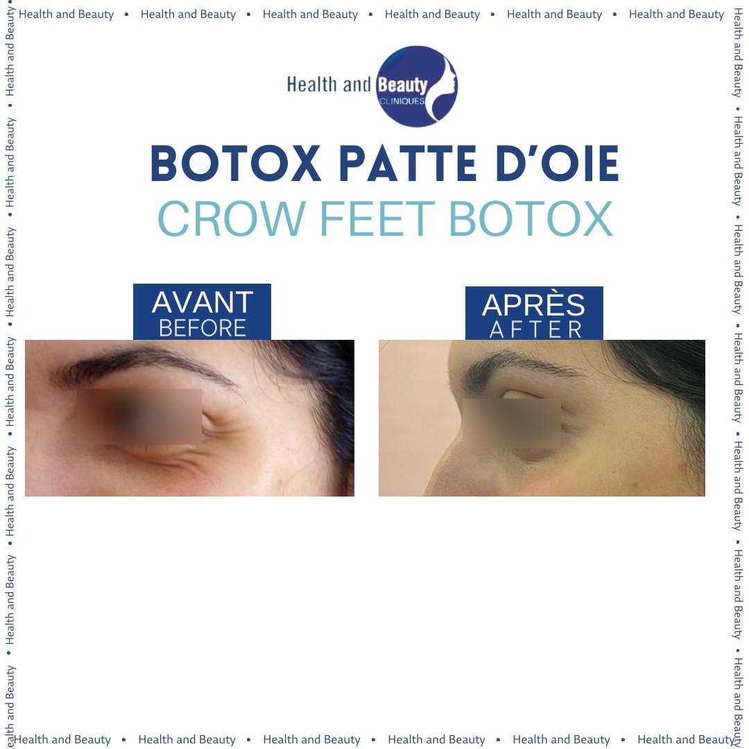 resultat-avant-apres-rides-botox-pattes-doie-crowfeet-wrinkles