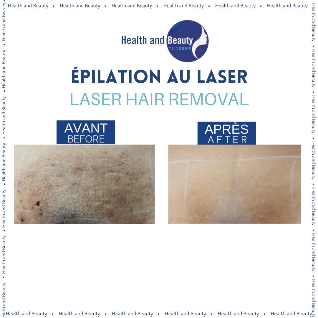 resultat-epilation-laser-maillot