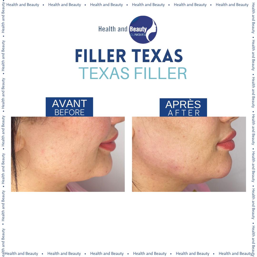 resultat-filler-texas-defined-jawline-acide-hyaluronique