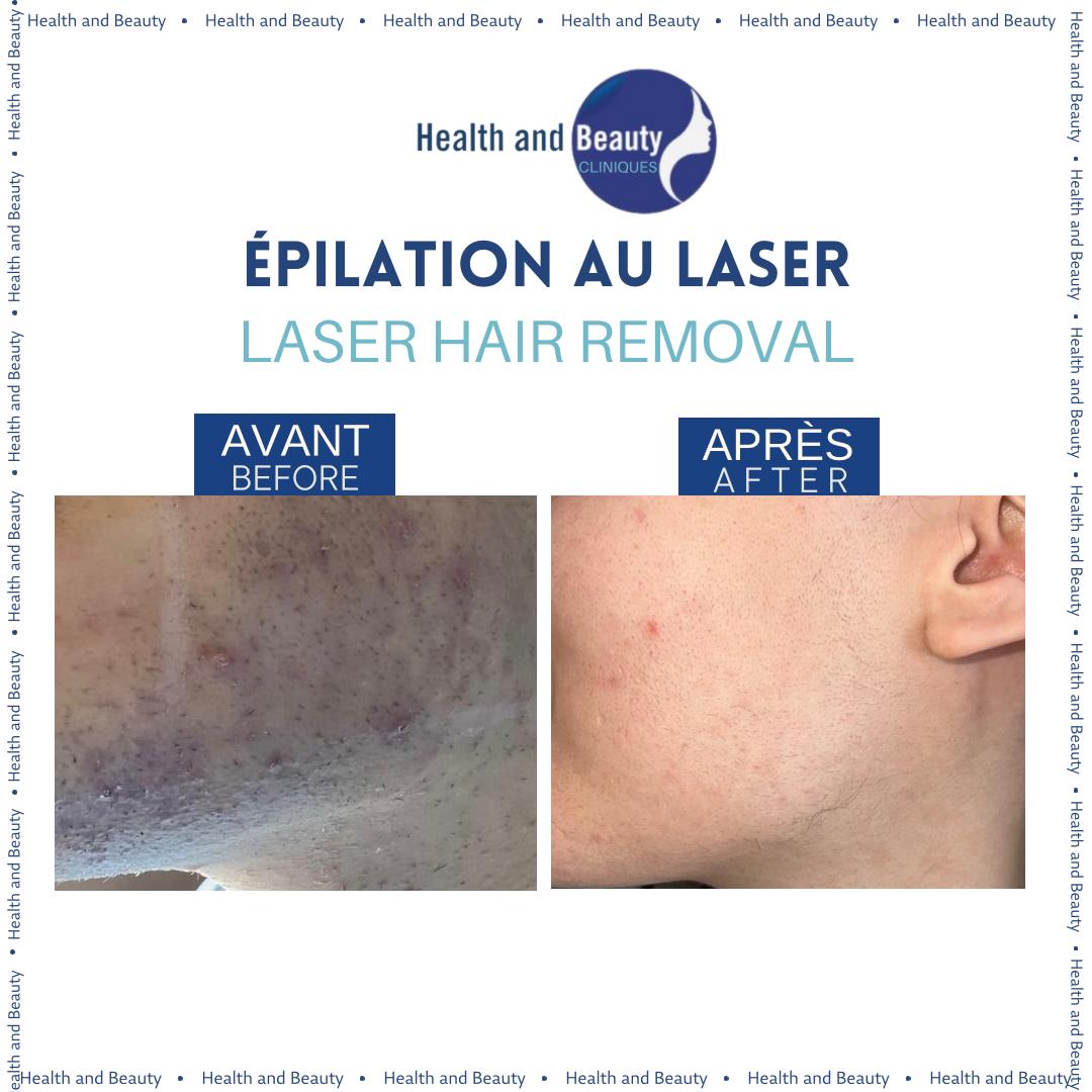 resultat-laser-visage-pour-femmes-aux-sopk