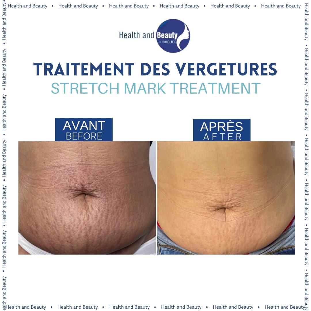 resultat-avant-après-mésothérapie-visage-health-and-beauty_maroc