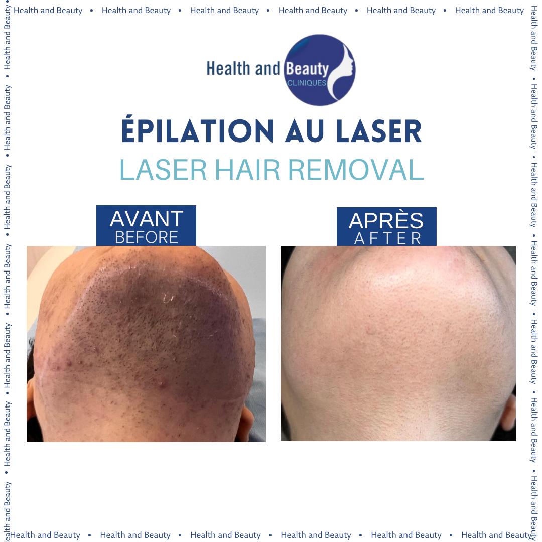 resultat-épilation-laser-menton